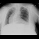 Ileus, small bowel, adhesions: X-ray - Plain radiograph
